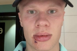 倒霉！哈兰德社媒晒自拍：被大巴车门撞了，缝了3针&看起来还挺好